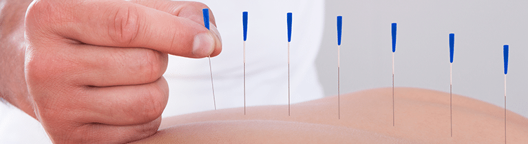 Acupuncture