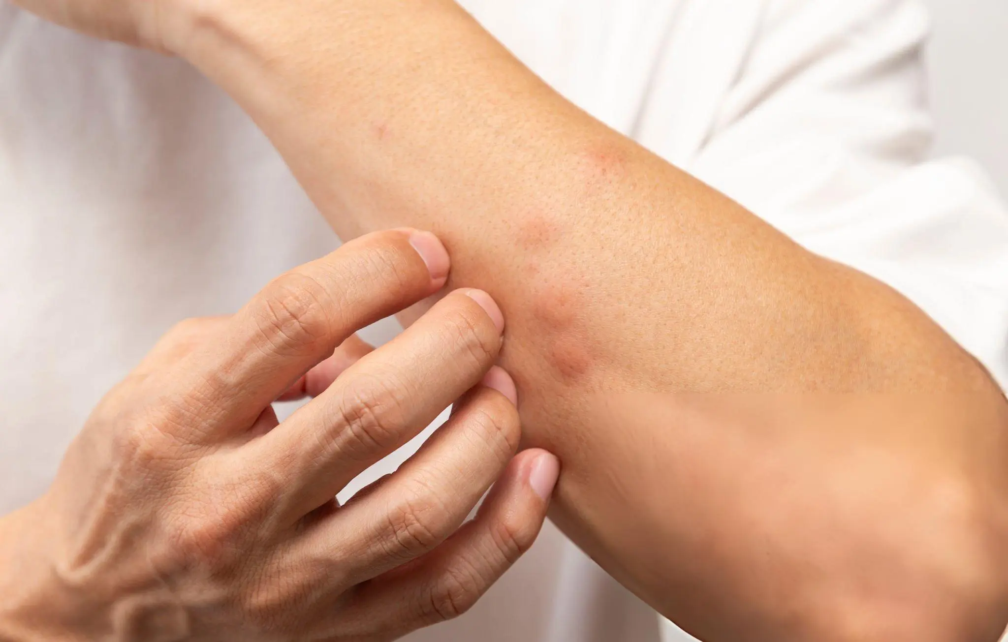 Insect Bites
